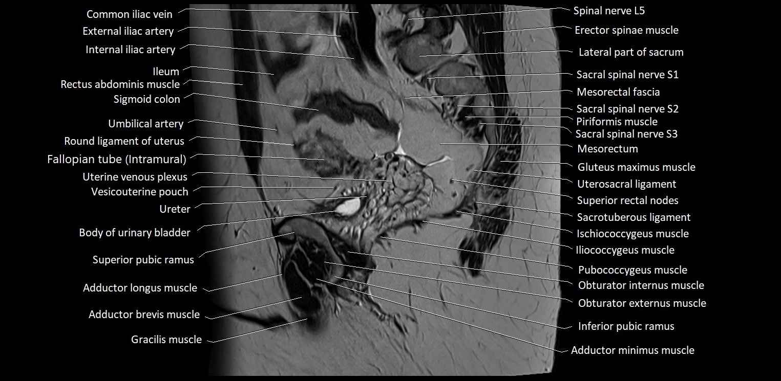 Sagittal cross sectional anatomy of female pelvis (MRI 3T) image 14.webp